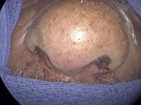 Florida Man Undergoes Surgery to Remove 150 Live Bugs from Nose
