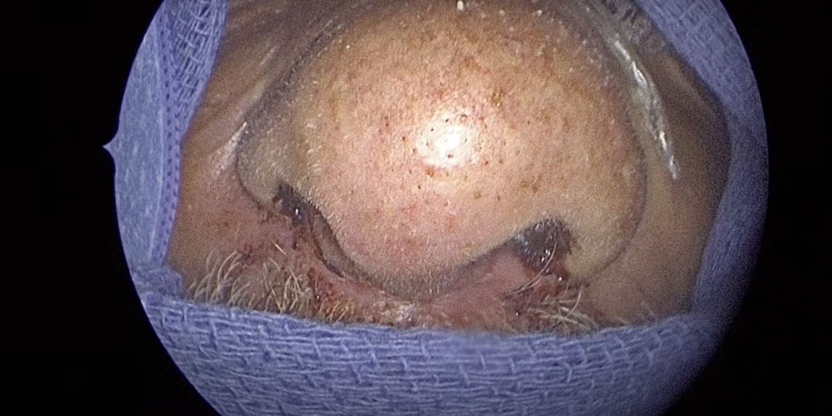 Florida Man Undergoes Surgery to Remove 150 Live Bugs from Nose